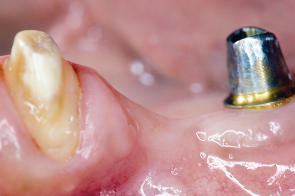 Como fazer a união de implantes a dentes naturais