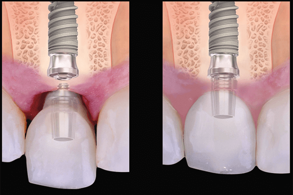 Perio One Base: uma solução periodontal estética