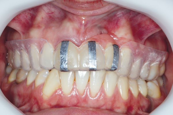 Recursos físicos facilmente confeccionados pelo clínico para otimizar os dados da tomografia computadorizada feixe cônico no planejamento para colocação de implantes dentários