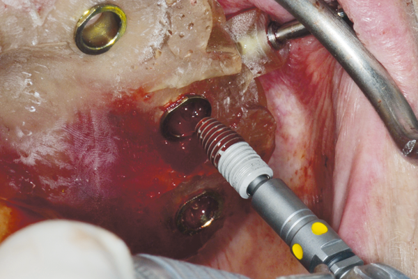 Guia cirúrgico indexado por implantes temporários com o sistema Dérig Guide