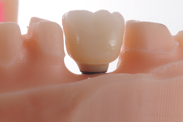 Simplificação da Prótese Dentária Digital e selamento da mucosa peri-implantar: perio one base concept