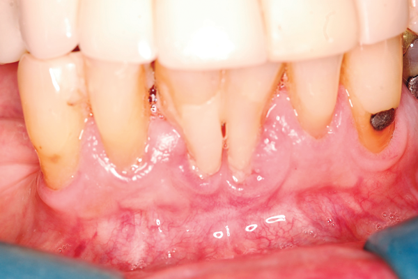 Uso de um biomaterial xenógeno como substituto ao enxerto gengival livre na área mandibular anterior com doença periodontal prévia – relato preliminar de um caso clínico