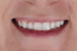 Cirurgia periodontal sem elevação de retalho para tratamento de sorriso gengival