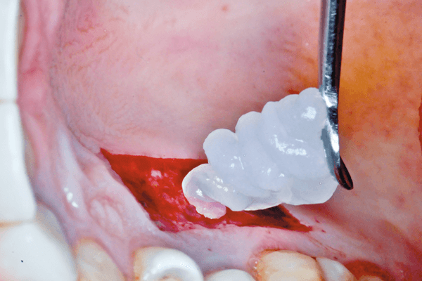 Uso do gel de oxigênio como otimizador da cicatrização tecidual em áreas doadoras e receptoras na técnica de enxerto gengival livre
