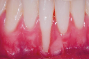 Cirurgia plástica periodontal para tratamento de recessão gengival isolada tipo II