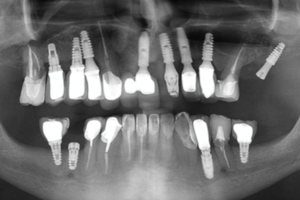 “Isso nunca me aconteceu antes” na Implantodontia