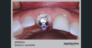 Técnicas e conceitos para atingir resultados de excelência na região anterior