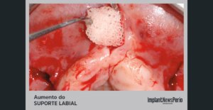 Reconstrução óssea do rebordo alveolar para aumento do suporte labial