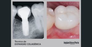 Caso clínico mostra reconstrução alveolar após exodontia de molar mandibular