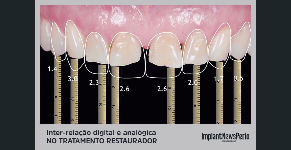 Caso clínico complexo traz desgaste dos dentes naturais por hábito parafuncional
