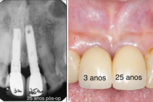 Estabilidade marginal peri-implantar