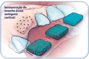 Biologia do enxerto ósseo autógeno: melhor em bloco ou particulado/raspado?