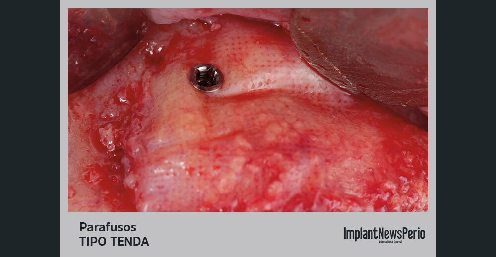 Caso clínico ilustra o uso de  parafusos tipo tenda em  procedimento regenerativo