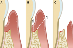 Tratamento periodontal cirúrgico: quando realizar?